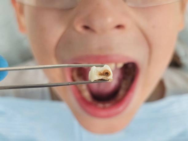 Best Emergency Tooth Extraction in Brookville, IN